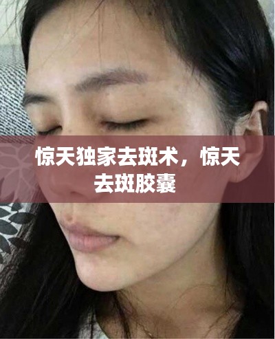 惊天独家去斑术,惊天去斑胶囊